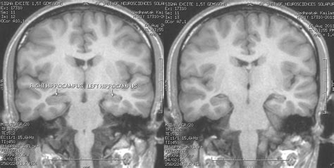 Dr Balaji Anvekar FRCR: Hippocampal sclerosis MRI