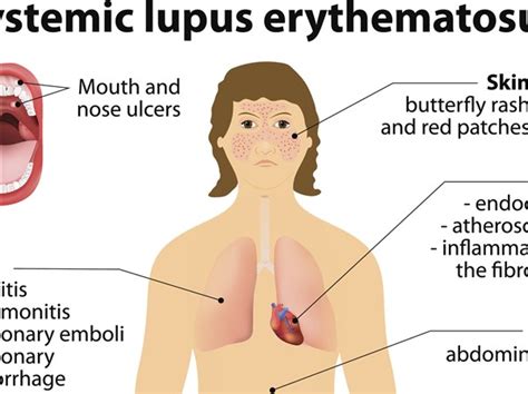 From rashes to joint pain, Lupus is an elusive disease where the body ...