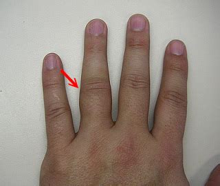 Finger sprain or dislocation