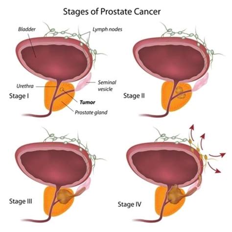 Why Everything You Know About Prostate Cancer Is Wrong