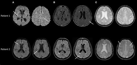 Frontiers | Cerebral Amyloid Angiopathy Related Inflammation With ...