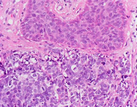 Pathology Outlines - Merkel cell carcinoma