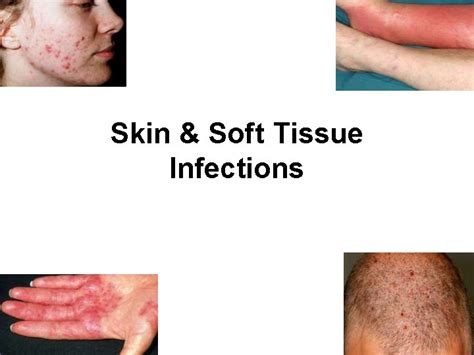 Skin Soft Tissue Infections Anatomy of the Skin