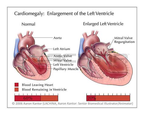 Cardiomegaly - Medical Terminology Blog