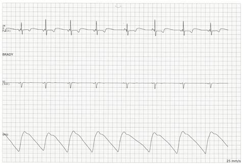 Practice EKG Strips