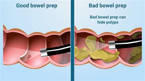 Colonoscopy | Procedure & Cost | Andrea Digestive Clinic