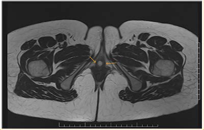 Urethral Diverticulum: MRI - Sumer's Radiology Blog