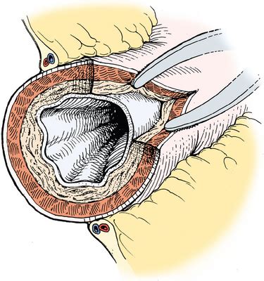 Pyloromyotomy | Basicmedical Key