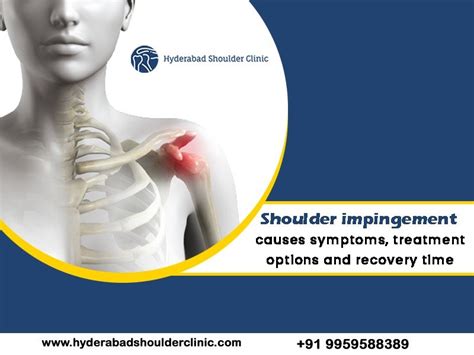 Shoulder impingement causes symptoms, treatment options and recovery time. - shoulder clinic ...