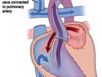 Glenn Procedure