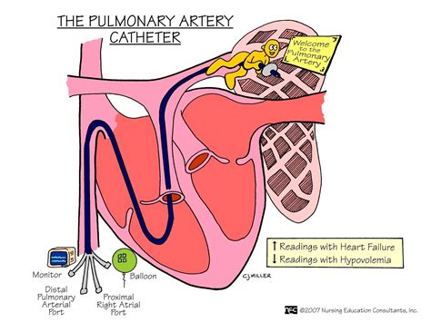 The Pulmonary Arterial Catheter | ONESTOPNURSING | Emergency room nurse, Nursing school ...