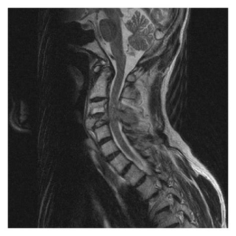 MRI of the cervical spine demonstrating erosive metastatic tumor of the... | Download Scientific ...