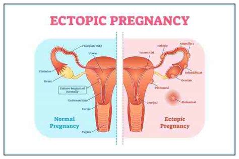 Pregnancy Bleeding: Causes And Treatment