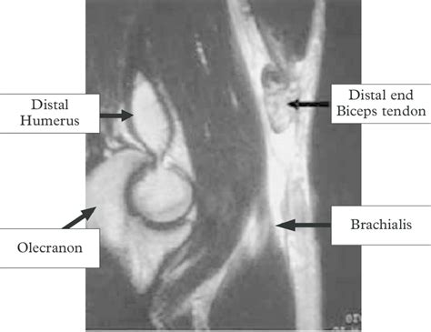 MRI ruptured biceps tendon. | Download Scientific Diagram