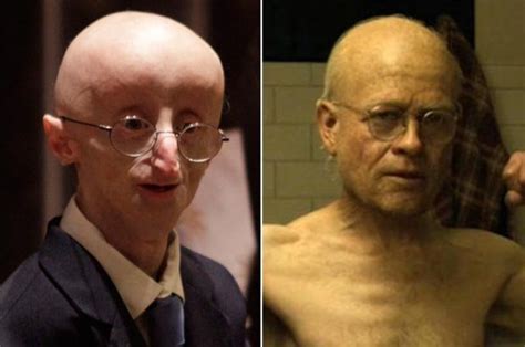 Real-life 'Benjamin Button | Daily Star