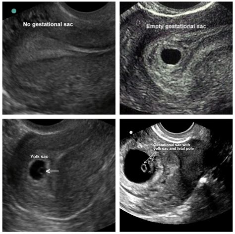 Clinical Concepts in Pelvic Ultrasound — Taming the SRU