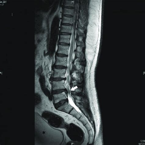 Lumbar Spine Mri Herniation