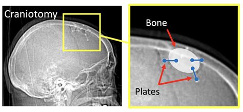 Craniotomy — Matthew Mian, MD