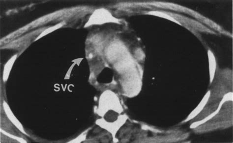 Figure 2 from CT findings in superior vena cava obstruction. | Semantic Scholar