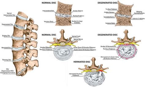 Intervertebral Disc Anatomy