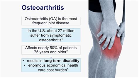 VIDEO: My Aching Knees - Osteoarthritis: Prevention, Detection, and Treatment - UCTV ...