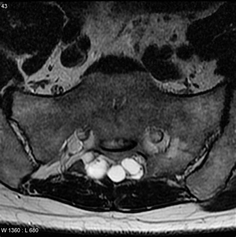 Tarlov Cyst Anatomy