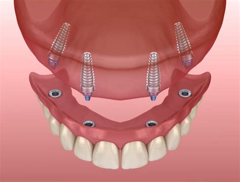 All-On-4 Dental Implants FAQs - California Dental Care - Dental Blog