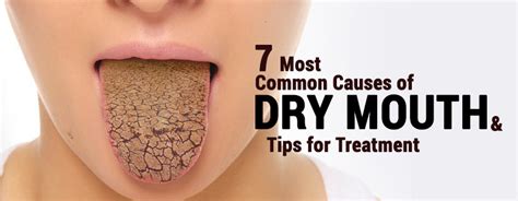 Causes Of Dry Mouth And Sore Lips - Infoupdate.org