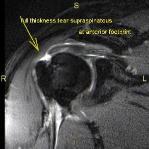 The Best Portland 3T MRI | Shoulder004a