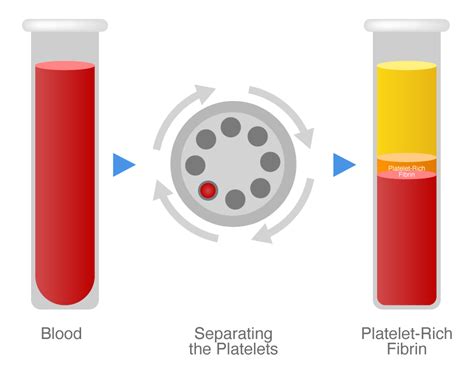 Platelet Rich Fibrin (PRF) | Dental Clinique