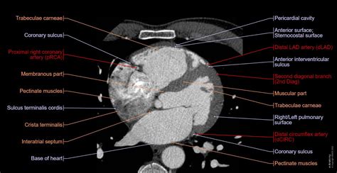 Anatomy of the heart and coronary arteries: normal anatomy | e-Anatomy