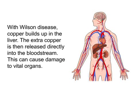 PatEdu.com : Wilson Disease