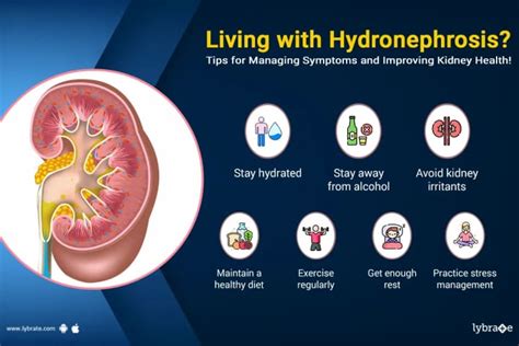 Hydronephrosis: Causes, Diagnosis, Treatment and Prevention - By Dr ...