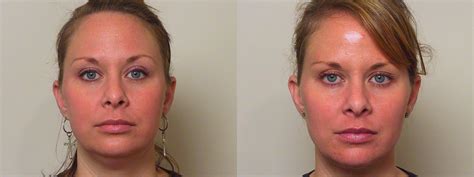 Neck Lift (Submentoplasty) Before and After Pictures Case 37 | Atlanta, Georgia | Buckhead ...