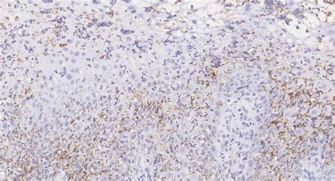 Treponema infection of the oropharynx | Ottawa Atlas of Pathology