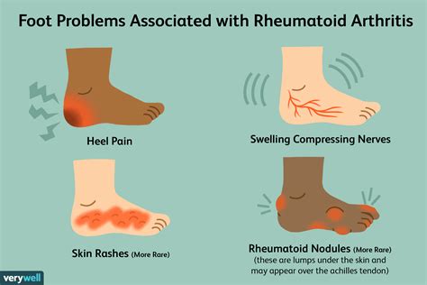 Pain in the Feet As a Symptom of Rheumatoid Arthritis