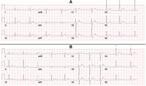 Psvt Ecg / Dr. Smith's ECG Blog: Paroxysmal SVT (PSVT) that ...