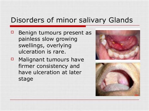 Salivary Glands Disorders