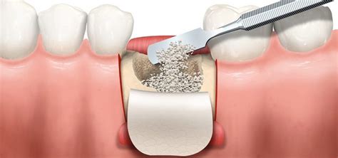 Bone Graft for dental implant - What you need to know..!