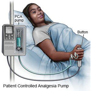 Patient Controlled Analgesia - What You Need to Know