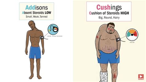 Cushings vs Addison's Add Flashcards | Quizlet