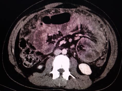 Tubercular peritonitis with peritoneal thickening and omental caking | Case, Radiology