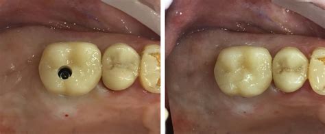 Screw retained crown on implant. | Stomatologie Dsmile v Praze | Moderní zubní ordinace