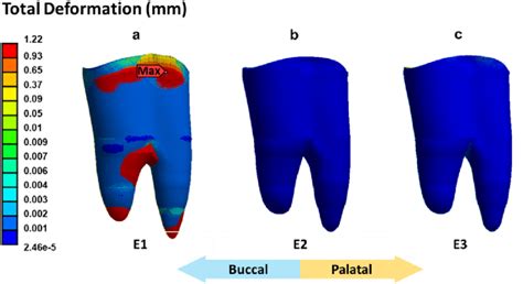 (a-c) PDL deformation distribution over the outer surface of the PDL ...