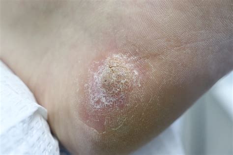 Viral Warts Symptoms