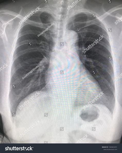 Chest Xray Shows Heart Slight Lt Stock Photo 1583824291 | Shutterstock