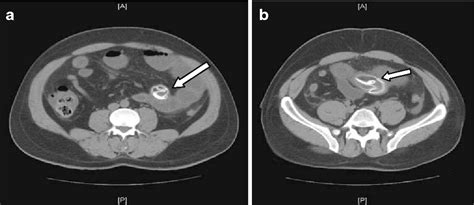 Figure 2 from Small bowel obstruction due to air-filled intragastric balloon. - Semantic Scholar