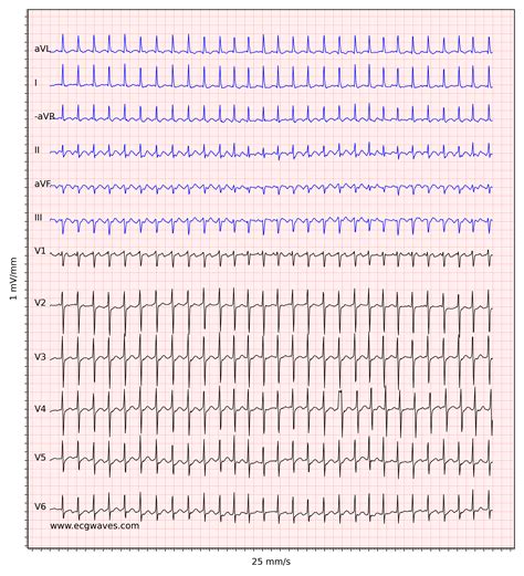 Ventricular Flutter Litfl Ecg Library Diagnosis