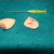 Pedunculated polyp from left palatine tonsil. | Download Scientific Diagram