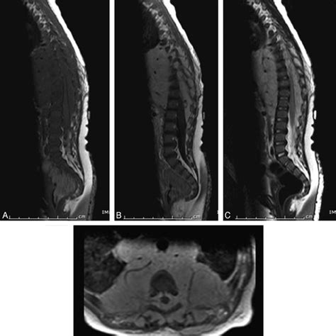 Typical CT findings of neuraxis hemangioma (patient 2). Precontrast ( A ...